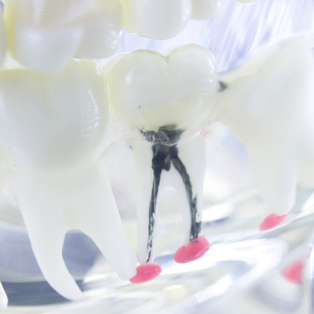 Root canal treatment at Glendale Dental Wellness